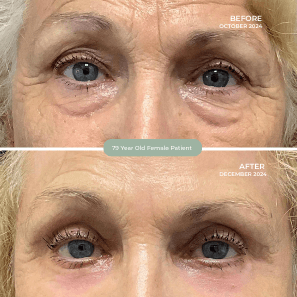 79 Year Old Female Patient